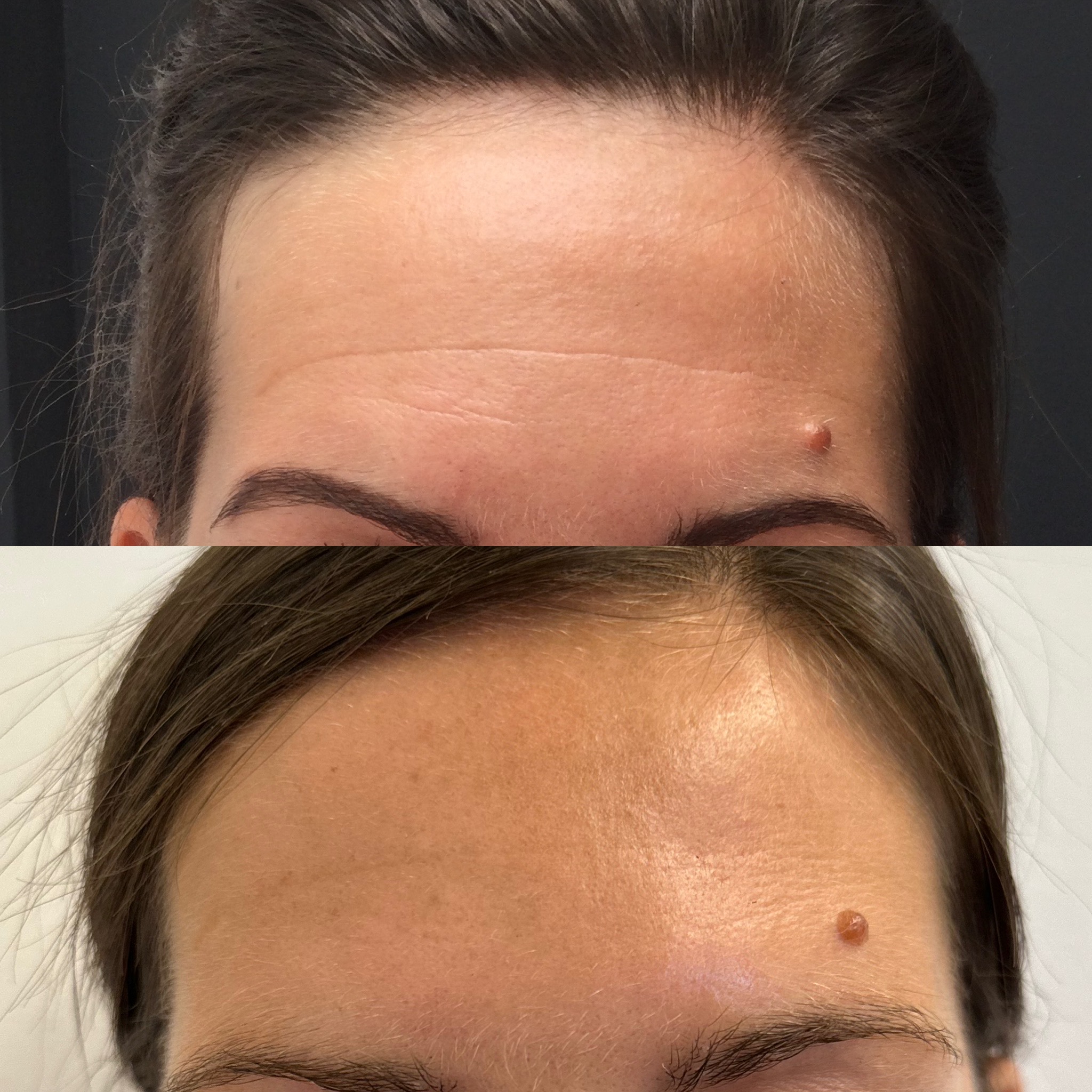 Botox voorhoofd voor (boven) en na (onder)