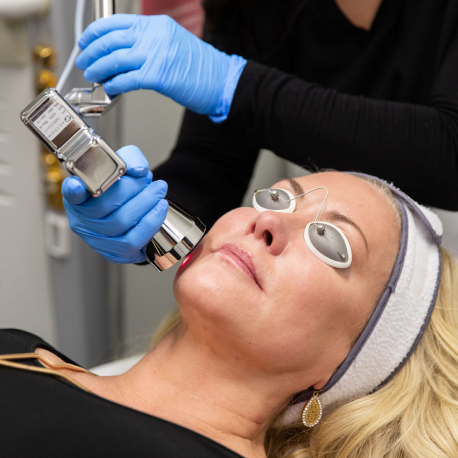 Sciton® MicroLaserPeel - MLP