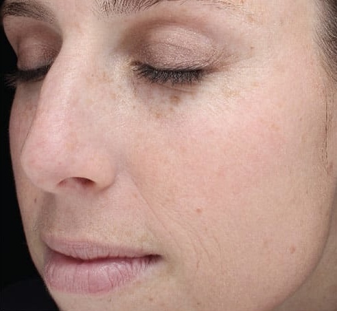 BBL HERO pigment voor en na
