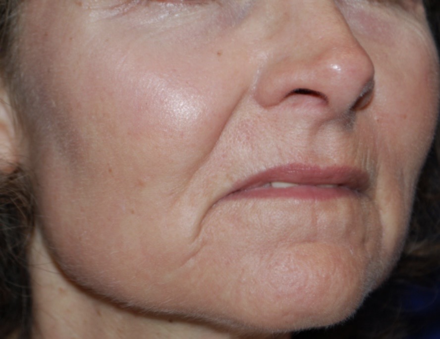 MLP 20 micron en ProFractional Heavy voor en na (1 sessie)