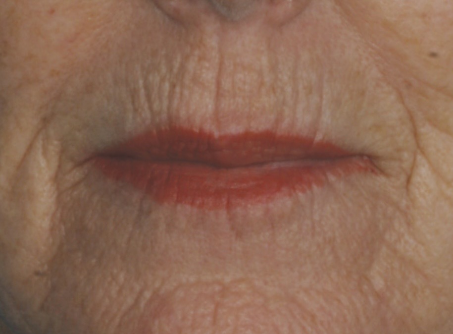 Sciton Resurfacing Contour TRL voor en na (1 sessie)