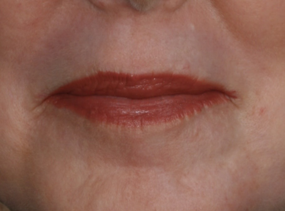 Sciton Resurfacing Contour TRL voor en na (1 sessie)
