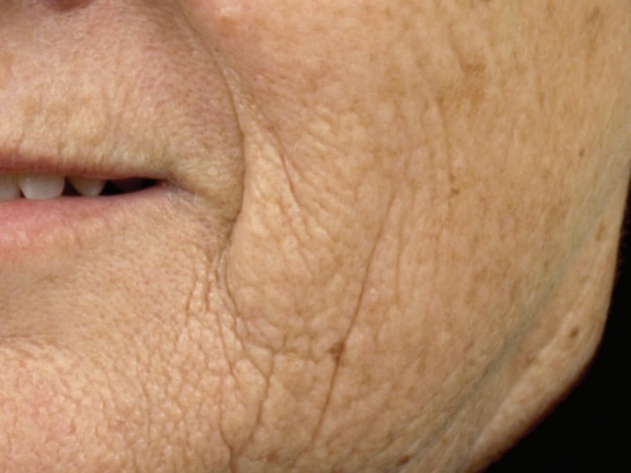 Sciton Resurfacing Contour TRL voor en na (1 sessie)