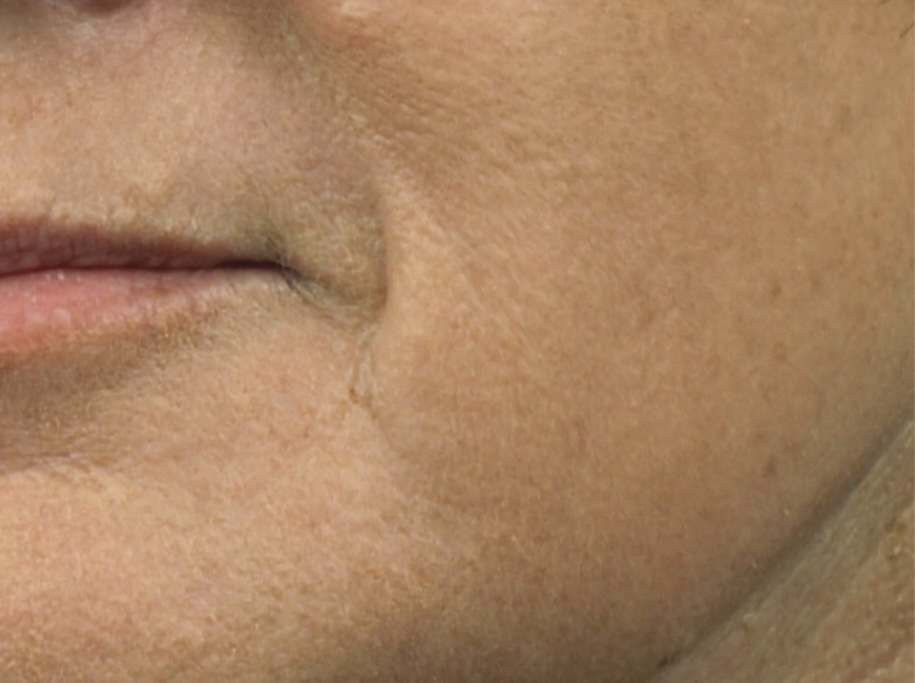 Sciton Resurfacing Contour TRL voor en na (1 sessie)