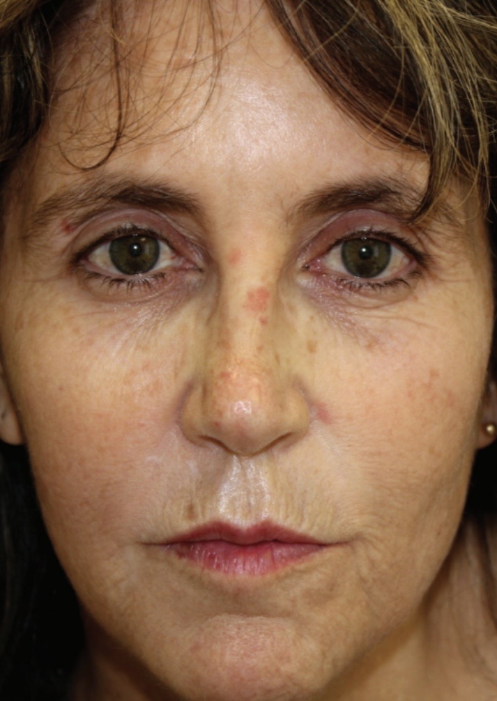 Sciton Resurfacing Contour TRL voor en na (1 sessie)