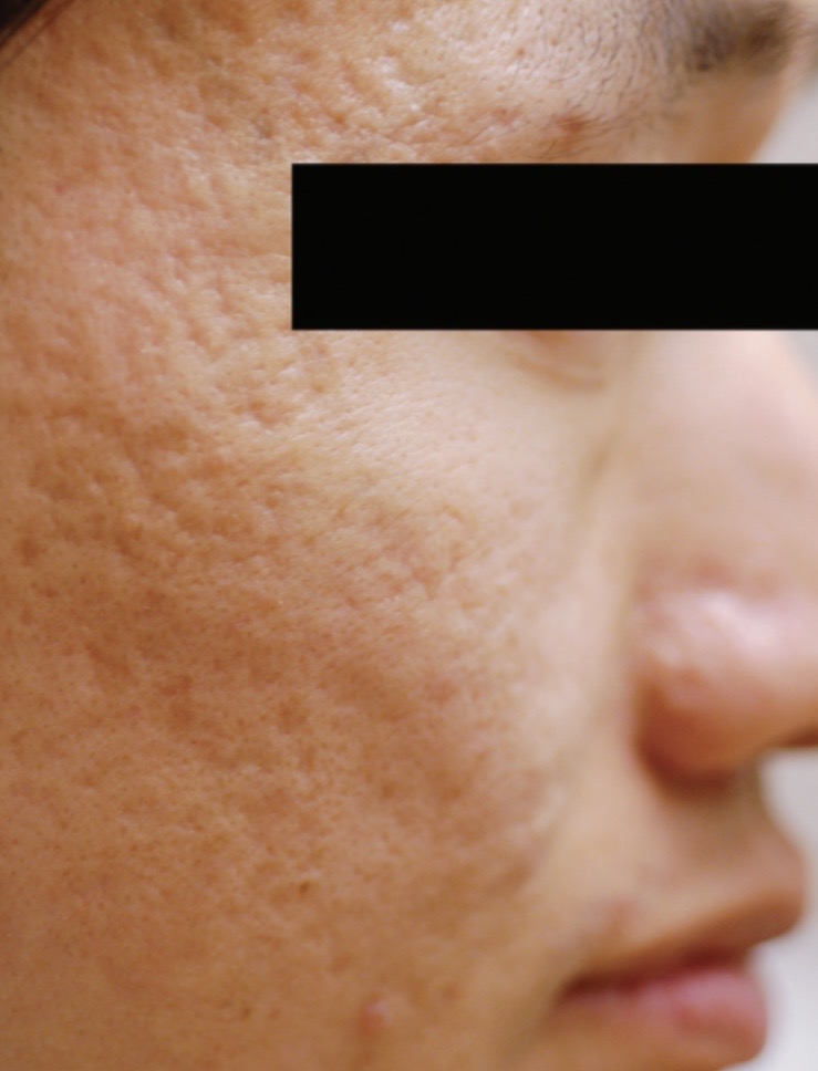 ProFractional Heavy en Contour TRL acnelittekens voor en na (2 sessies)
