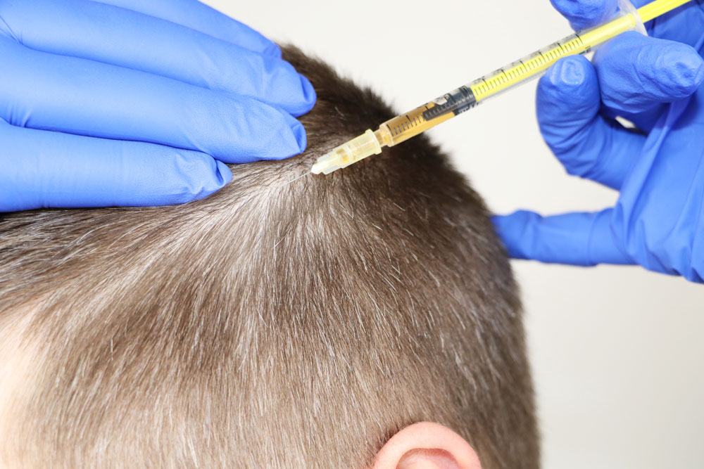 Dutasteride mesotherapie