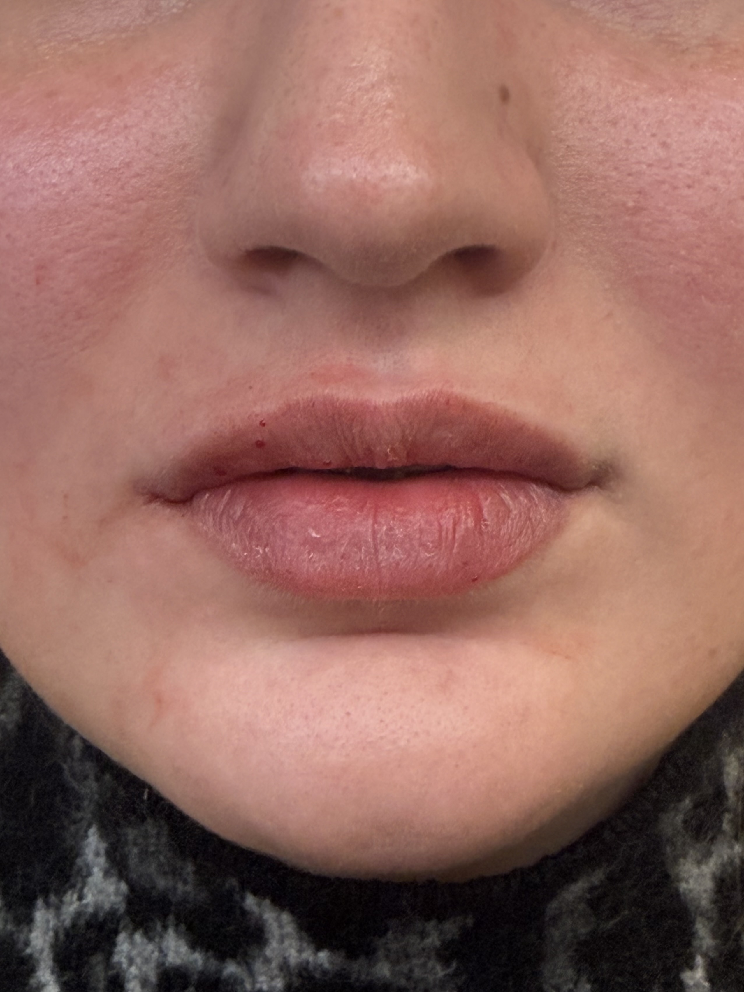Lippen voor en na
