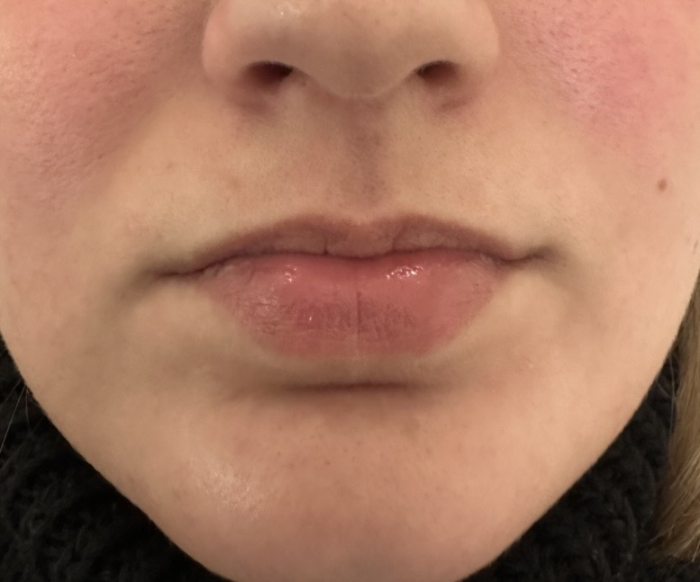 Lippen voor en na